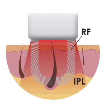 Illustration of the Intense Pulsed Light (IPL) and Radio Frequency (RF) energies used in the Iluminage Touch and Iluminage Precise Touch