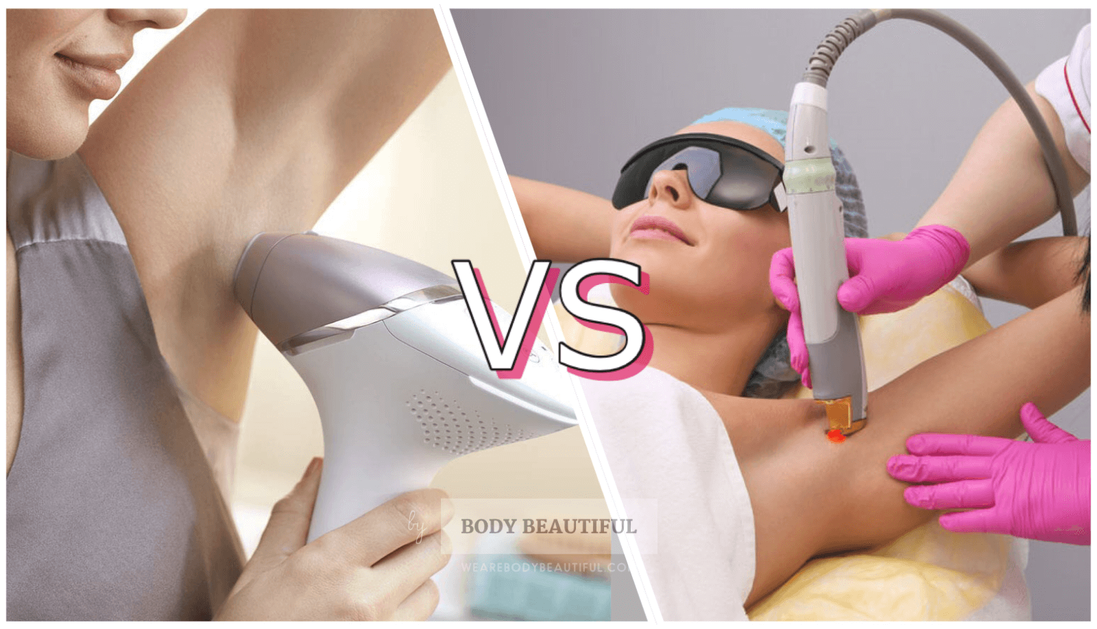 Laser hair removal at home vs professional treatments
