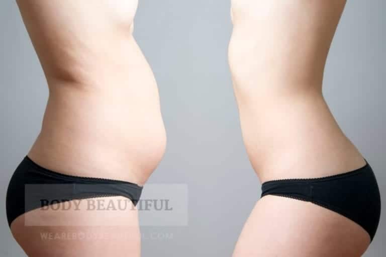 photo of a lady tummy with stubborn fat, and then presumably the same lady with a sculpted, slim tummy. It looks airbrushed to me, but it is stock photo so what can you expect.