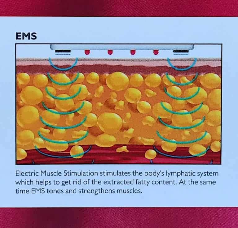 Diagram showing the EMS waves moving through the treatment area fat cells