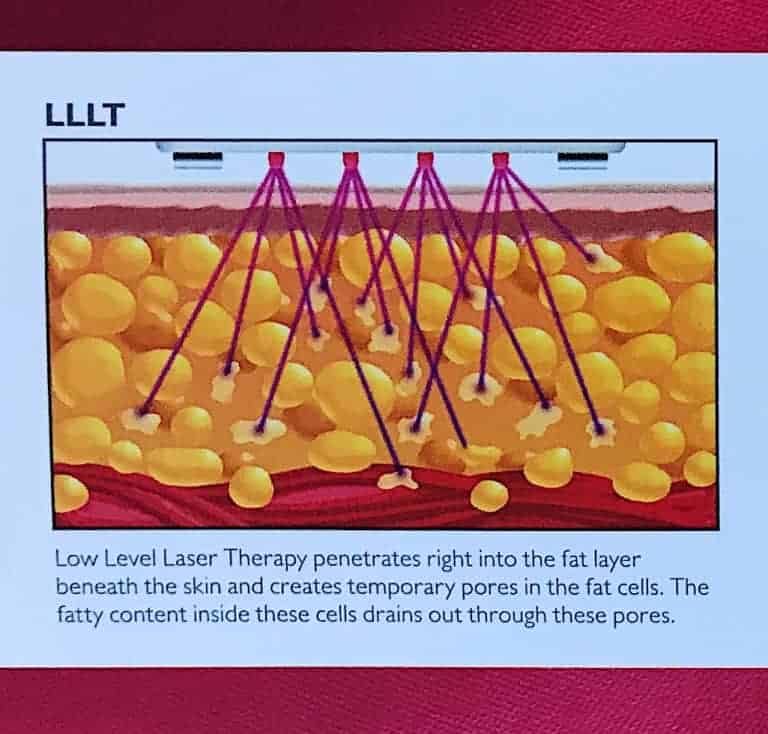 Diagrame showing the LLLT laser penetrating the subdermal fat layer and the fat draining from the fat cells.