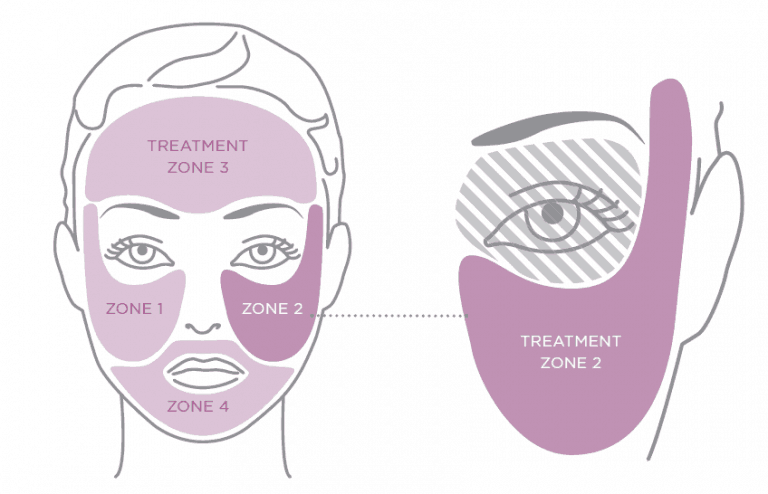 Graphic from the Tria laser user manual of the 4 facial zones to use the Tria laser on