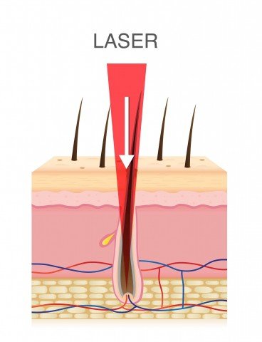 At home laser hair removal 101: your fuzz-free guide