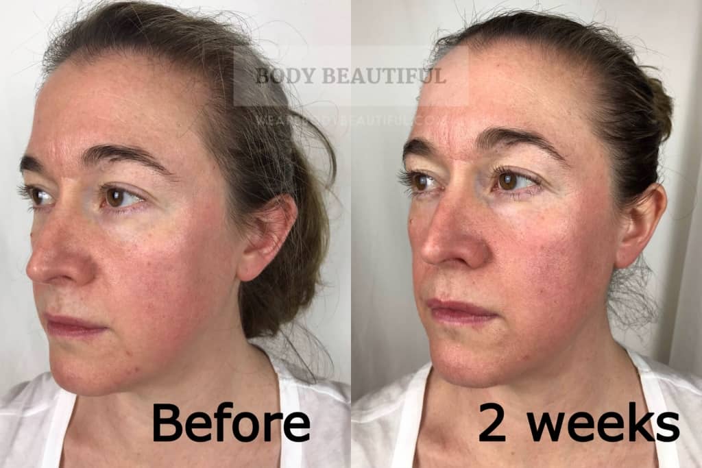 liar Street unforgivable Tria Age Defying Laser review: before and after photos