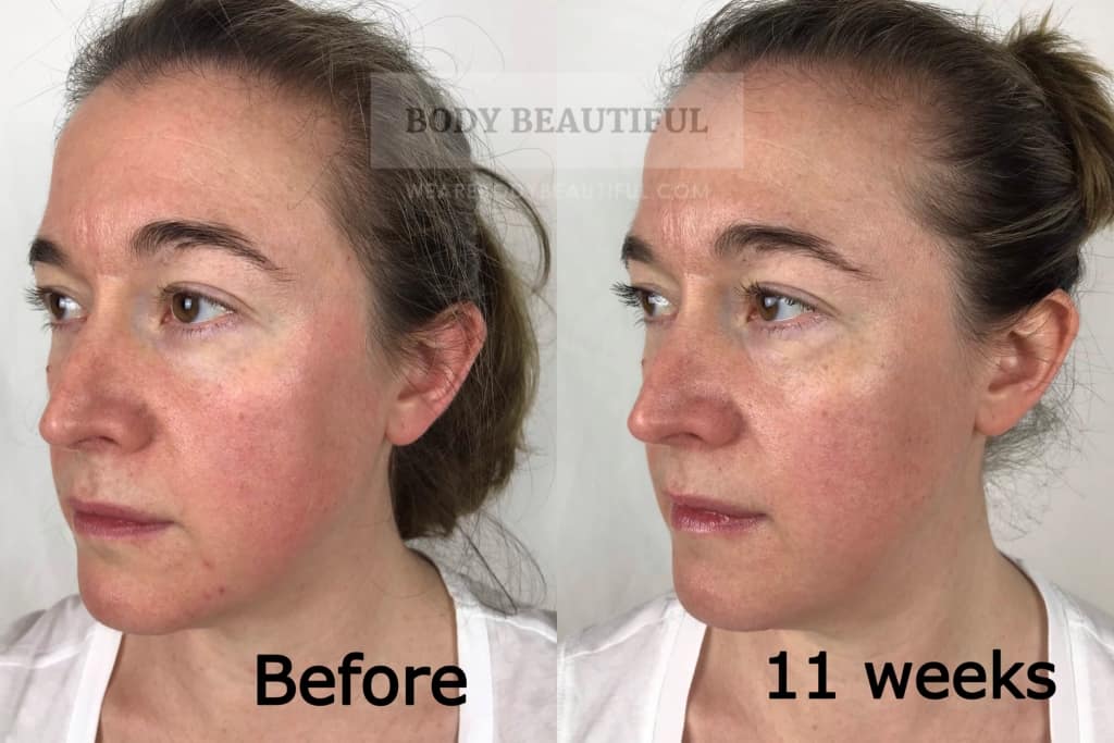 Before vs after 11 weeks from the start of the Tria Age Defying Laser trial.