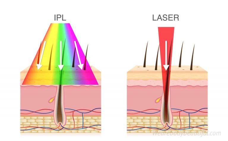 Melanin in our hairs absorbs multi IPL wavelengths and a single monochromatic laser wavelength