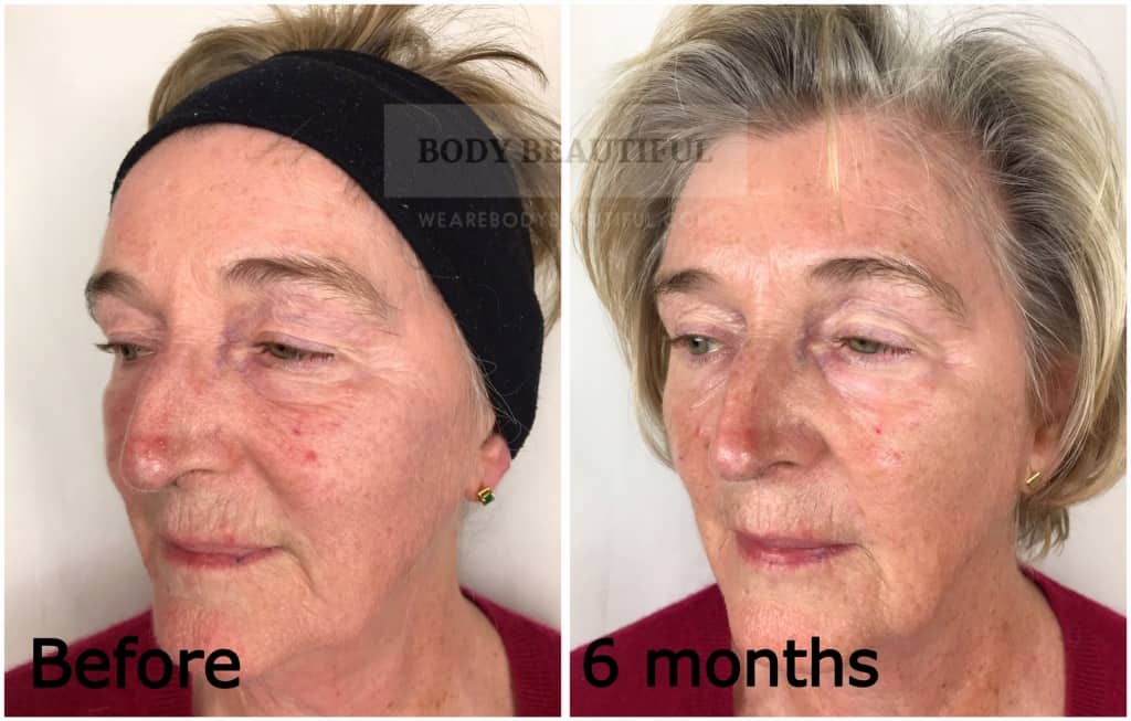 Mira-skin ultrasound review before vs after 6 months comparison using the Mira-skin system
