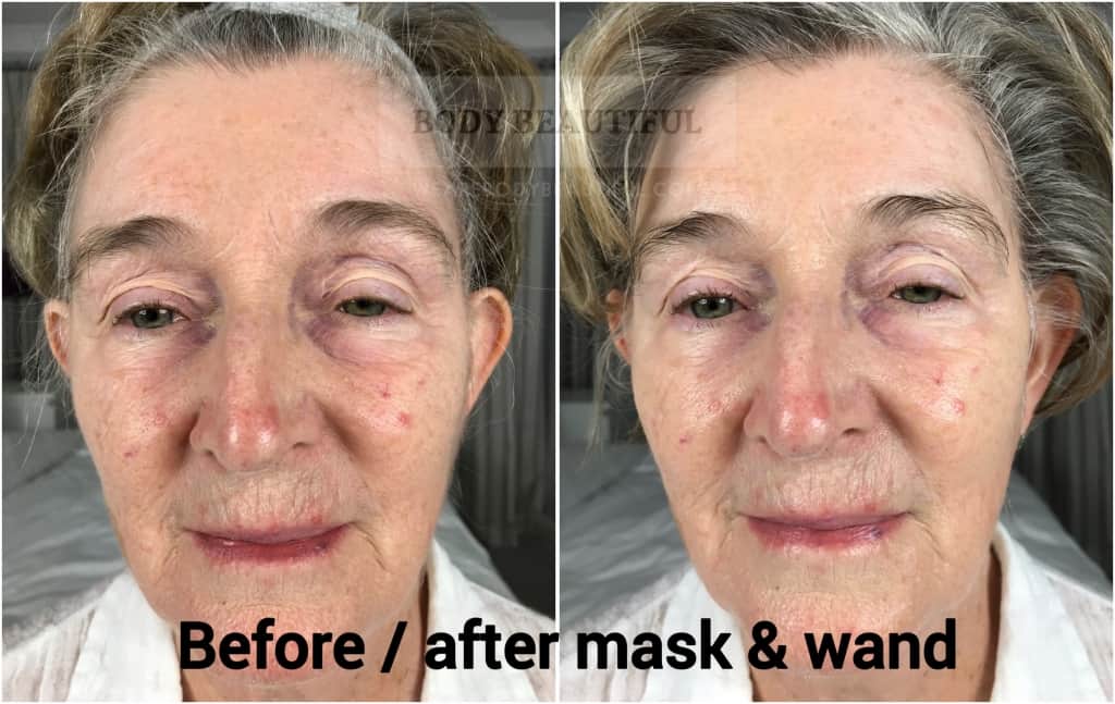 Mira-skin ultrasound review before vs after the Mira-skin hyperhydration mask with ultrasound boost. Results are impressive!