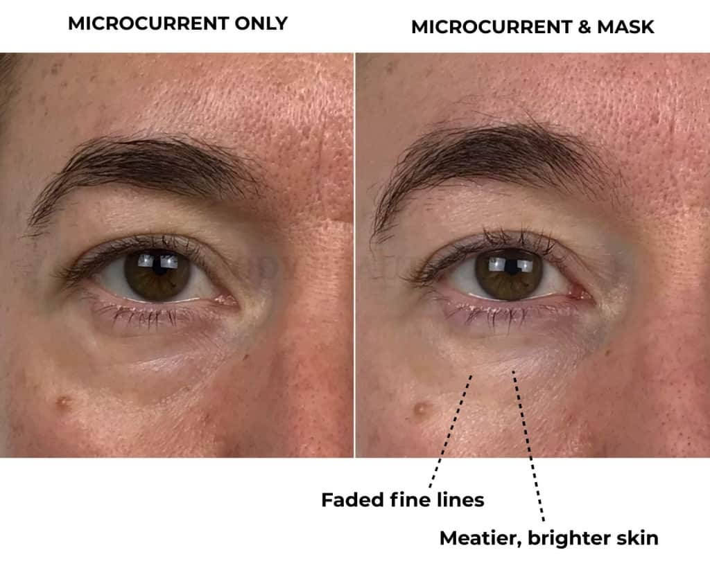 My CurrentBody skin Light therapy mask review before and after 4-weeks close up of my smooth and bright under eye area using along with home microcurrent (Nuface). 