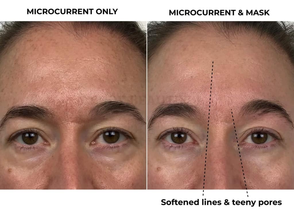 My CurrentBody skin Light therapy mask review before and after 4-weeks close up of my softened forehead lines along with home microcurrent (Nuface). 
