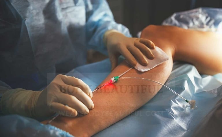 An RF probe inserted into a patients leg to heat a varicose vein in Surgical Radio Frequency ablation