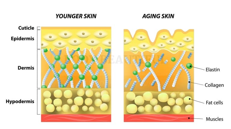 Cross section diagram of young skin with a strong collagen and elastin matrix, next to another of aging skin where the matrix isbroken down and weeker, and surface skin wrinkled. RF skin tightening remodels/rebuilds a damaged skin matrix.