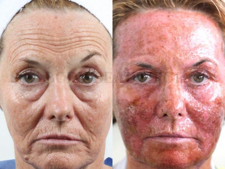 Side by side patient comparison showing red raw skin that's healing after a CO2 ablative laser treatment 