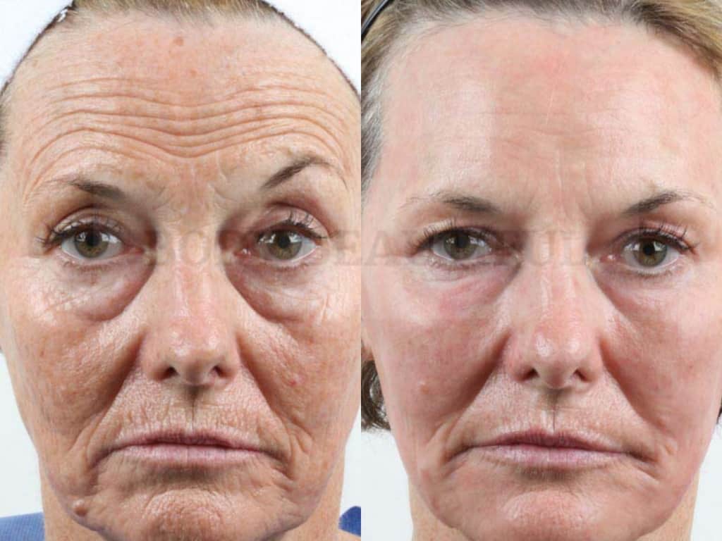 Effects of laser resurfacing & professional vs home devices