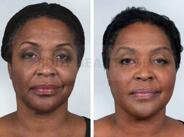 Side by comparison of before and after photos for dark skinned non-ablative laser resurfacing female patient 