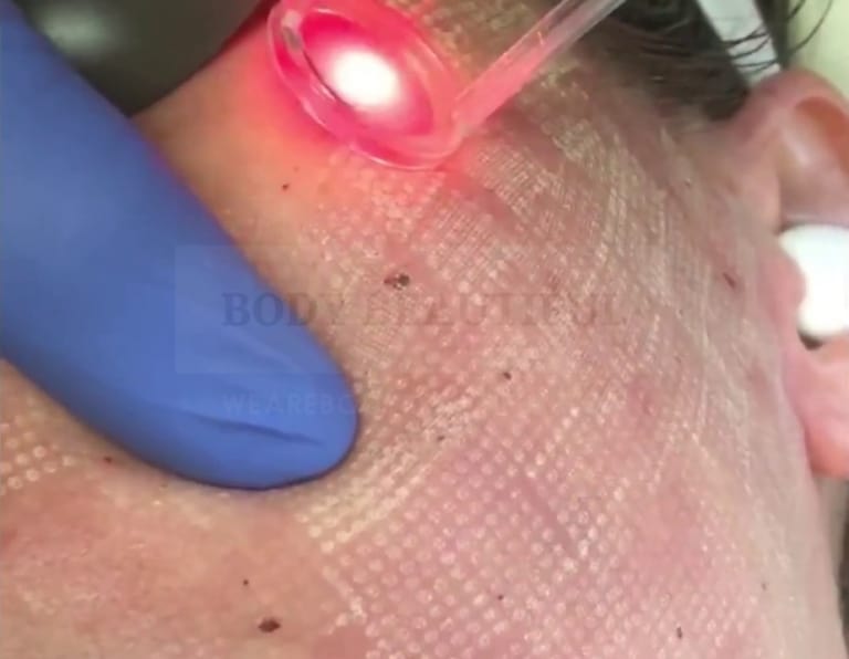 Close-up pattern of tiny fractional laser dot-zaps on the skin
