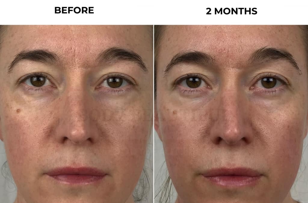Extreme close-up of my before &  2-month update photos to show how my skin texture & hydration has improved after using the Nuface Trinity for 2 months.