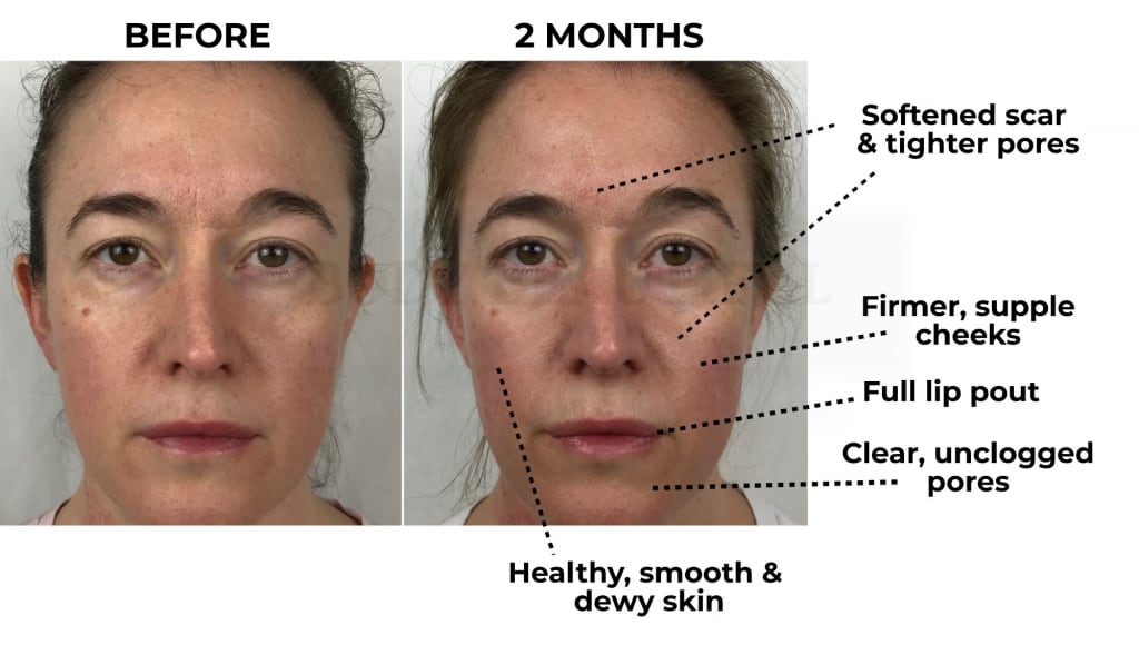 My Nuface Trinity trial forward facing before photo next to 2 month photo, with improvements labelled.