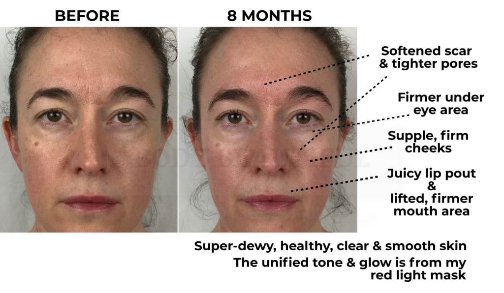 My Nuface Trinity trial forward facing before photo next to 8 month photo, with improvements labelled.