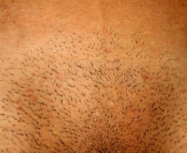 Close up photo of short stubble on human skin