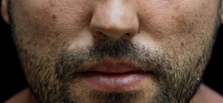 Close up of a man's dark stubble which could be removed or groomed by professional laser hair removal