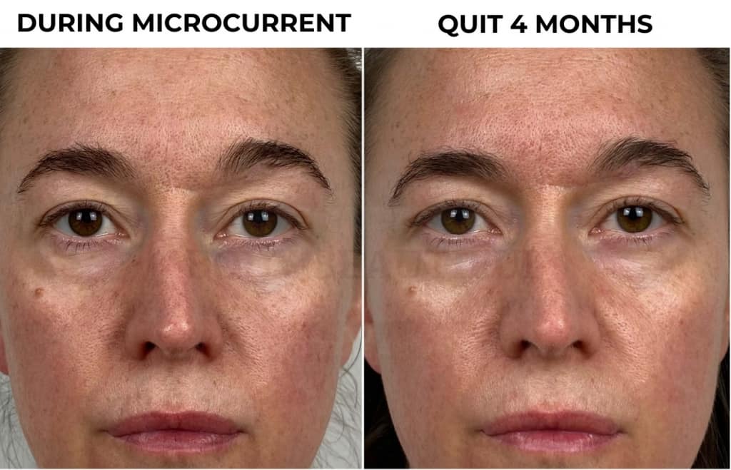 Close up of my skin: My comparison photos of my face during microcurrent & red light, and 4 months after quitting microcurrent
