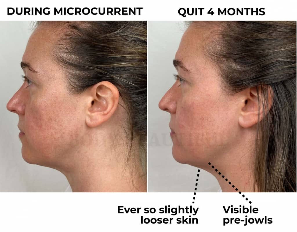 Side profile comparison photos of during microcurrent and 4 months after quitting