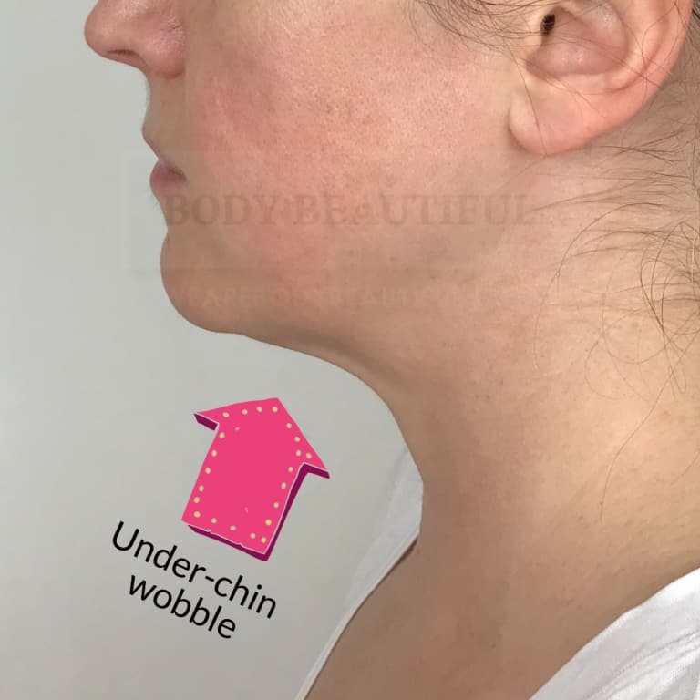 Ugh. Side profile view of y under-chin wobble