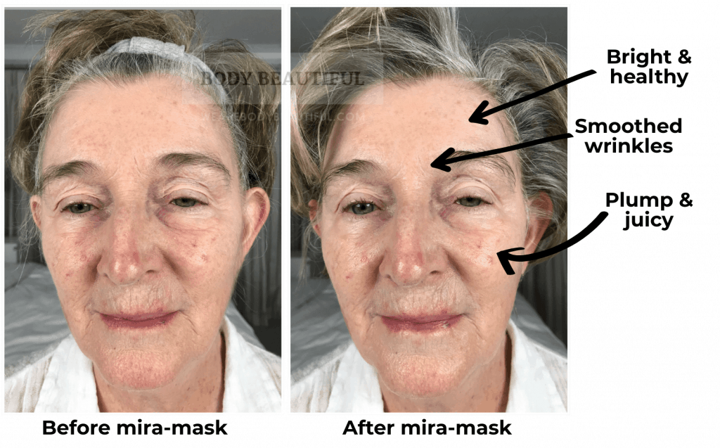 Mira-skin ultrasound review before vs after the Mira-skin hyperhydration mask with ultrasound boost. The results are impressive!