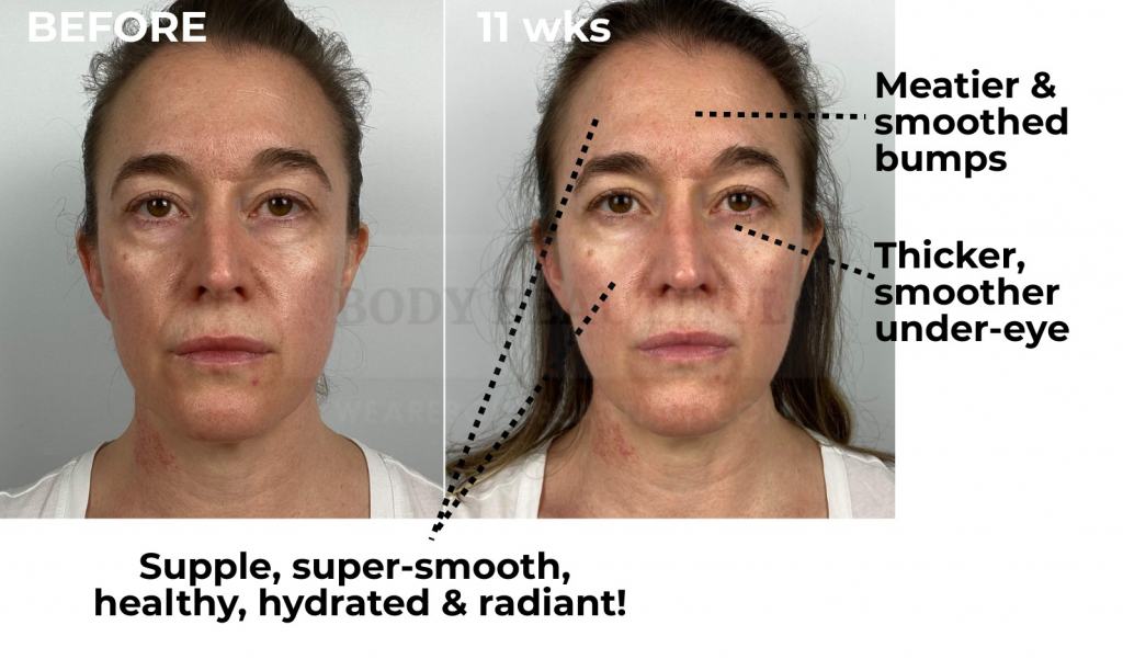 After completing an 8-week start-up stage with the Tripollar STOP and doing a few weekly top-up sessions I see further improvements! My forehead is meatier and even smoother, my skin is generally supple, super-smooth, healthy, hydrated and radiant. And my under eye area is smoother, thicker and less crepey too!