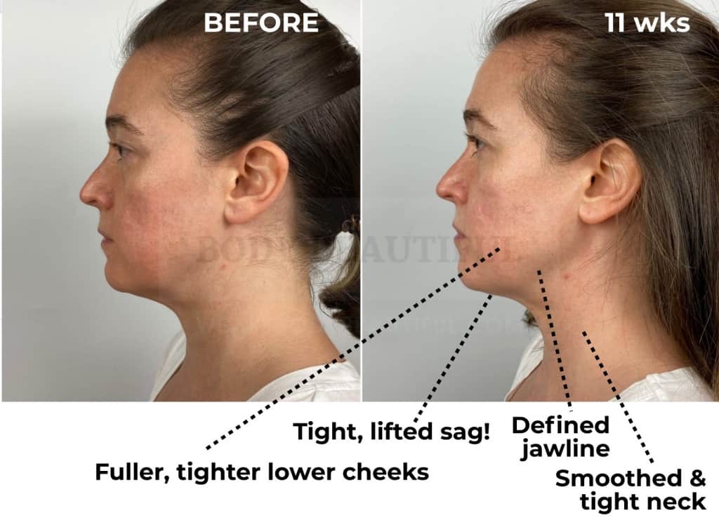 After 11 weeks of using the Tripollar STOP this side profile comparison photo shows my under chin sag has lifted even more! Yay! My jaw line is defined, and my neck smoothed and tight. My lower cheeks are full, supple and tighter too. 