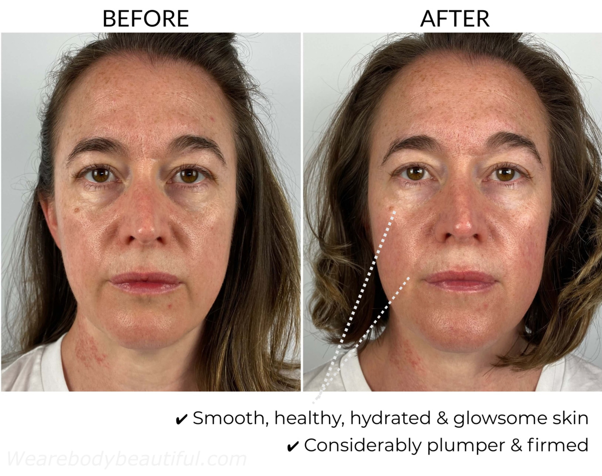 Before and after 5 weeks comparison using the Dermalux Flex MD light therapy kit: My skin is smooth, healthy, hydrated & glowsome! It is considerably plumper & firmed.