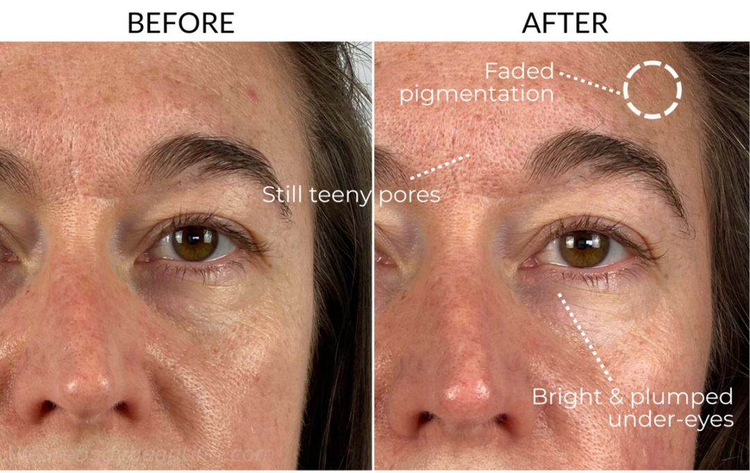 Dermalux Flex MD review before and after light therapy for 5 weeks comparison photos: this close-up comparison of my leff my eye shows reduced dark shadows, plumped fine lines, my pores are still teeny and how a red marks from an old scar is fading.