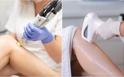 Laser vs IPL hair removal: which is best?