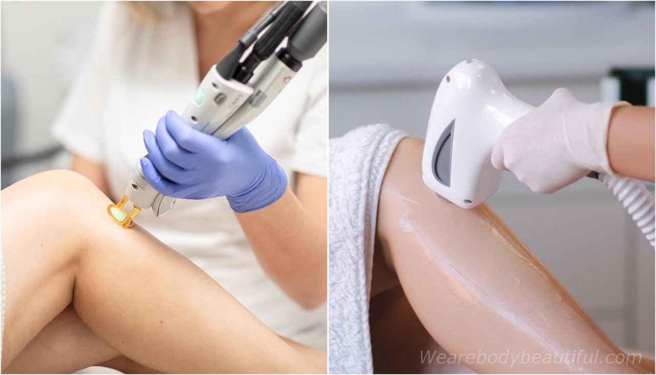 Which is best: laser or IPL hair removal?