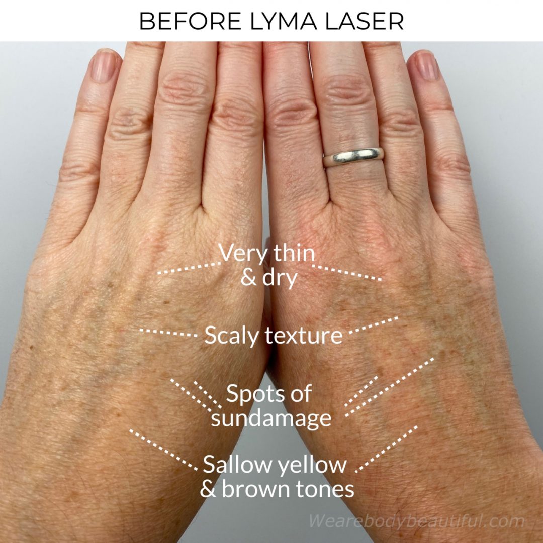 My LYMA laser before and after trial: Photos of the backs of my hands before using the LYMA laser. The skin is very dry, thin and with a scaly texture and look. It's a sallow yellowy-green and orange -brown colour with dark spots of sun-damage. They are crinkly old-lady hands 😔