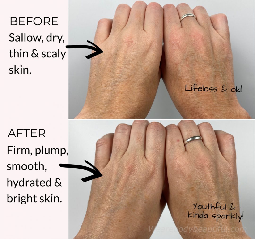 My LYMA laser before and after trial: Both hands comparison before and after using the LYMA laser for 4 months. BEFORE: dry, sallow, thin and scaly skin. AFTER: Firm, plump, smooth, hydrated & bright skin. Yay!