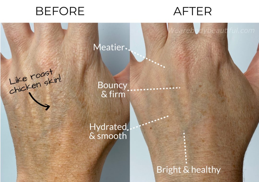 My LYMA laser before and after trial: Before and after comparison of my left hand. The skin is now meatier, bouncy & firm, smooth & hydrated, bright & healthy!