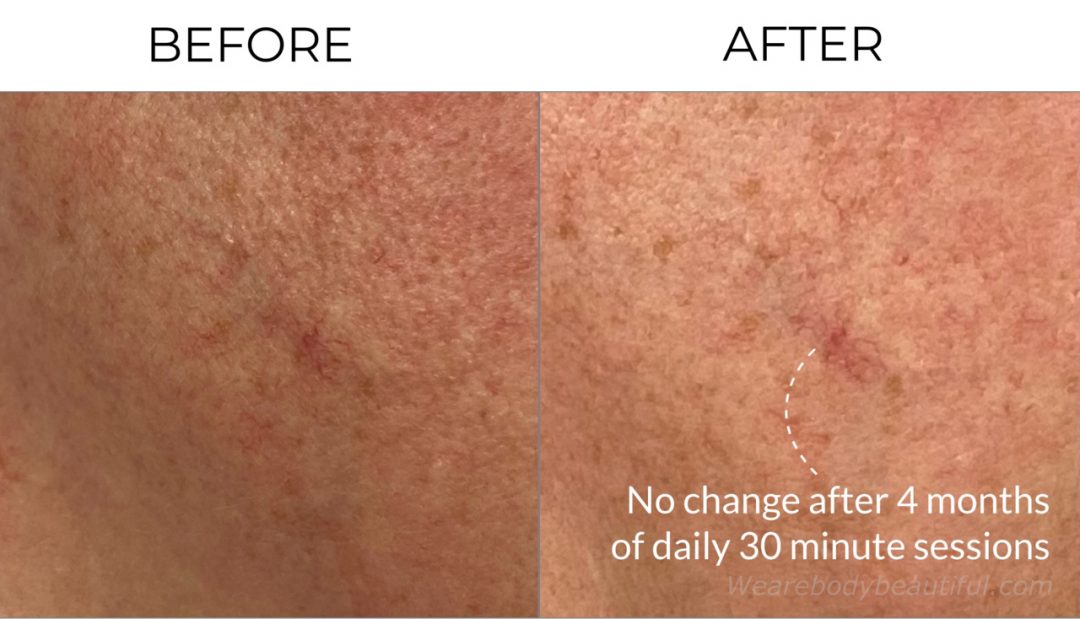 My LYMA laser before and after trial: Close-up omparison before and after LYMA laser photo of my red spider vein. Yup, no change after 4 months...