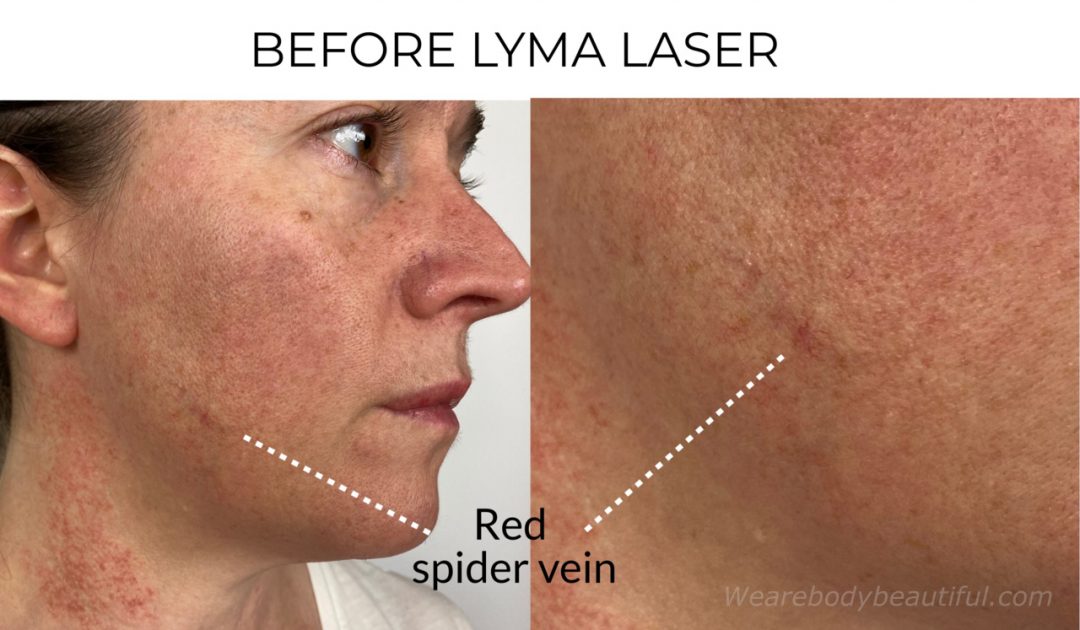 My LYMA laser before and after trial: Photos of the small red spider vein on my right cheek before using the LYMA laser, which I hope will dissolve and fade this somewhat.