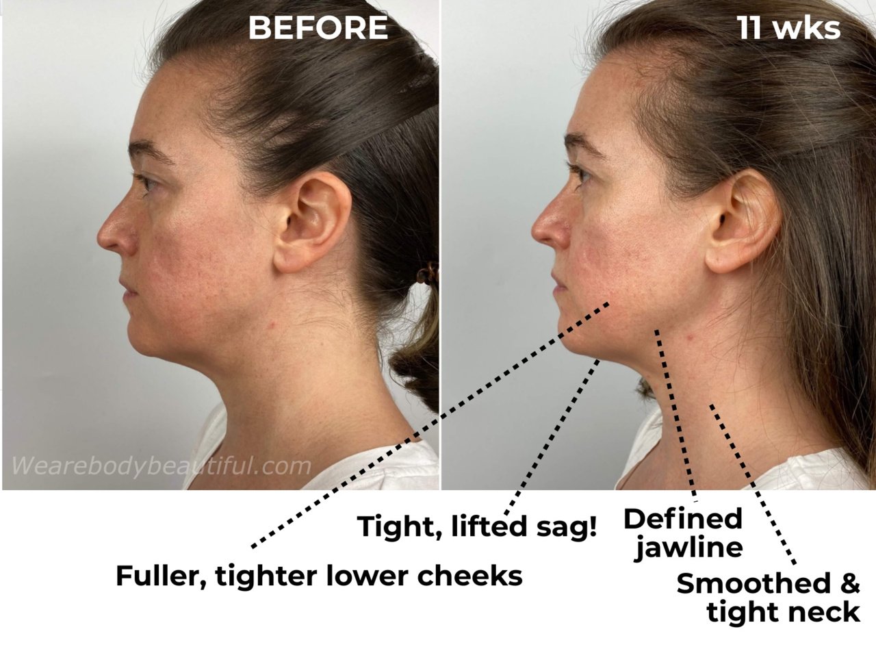 Before and after 11 weeks of using the Tripollar STOP VX comparison photos; it's given me fuller & tighter lower cheeks, a tight and lifted chin sag (YAY😁!), a more defined jawline and a smoothed and tight neck too...