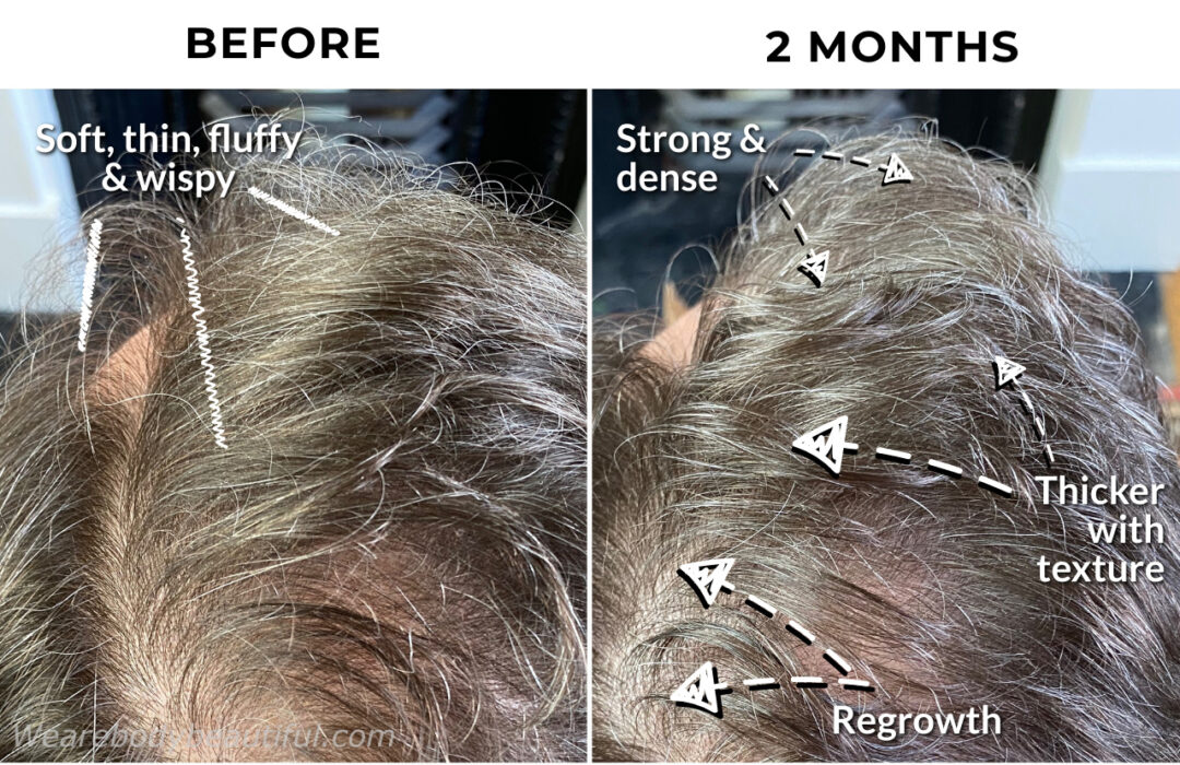 In this close up of hair treated with the CurrentBody Skin LED hair regrowth helmet for 2 months you can see stronger and denser hair along the side and top hairlines. The hair is fuller and far less soft, thin, fluffy, wispy and fly away. The texture is thicker with lift and volume.