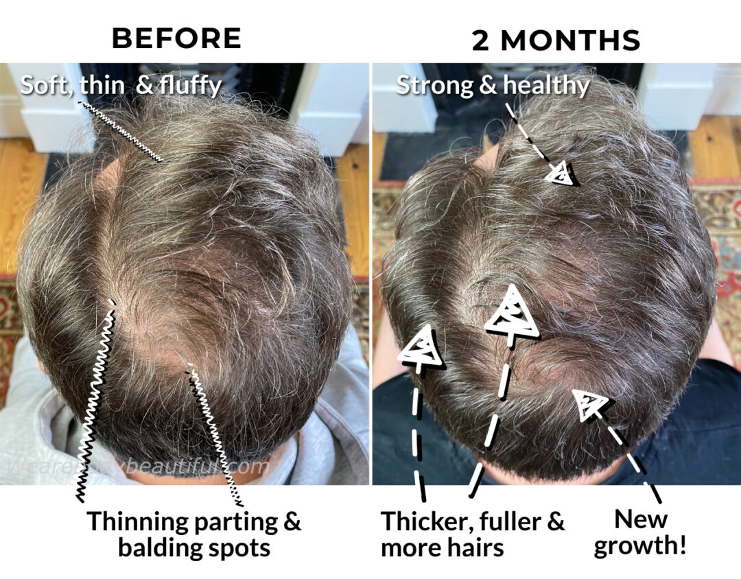 After 2 weeks using the CurrentBody skin LED hair regrowth helmet daily, there’s thicker, fuller and more hairs growing. It’s noticeable around the thinning crown and parting areas, although you can still see the scalp. Overall, the hairs look thicker, shiny and stronger, with more shine, health and vitality.