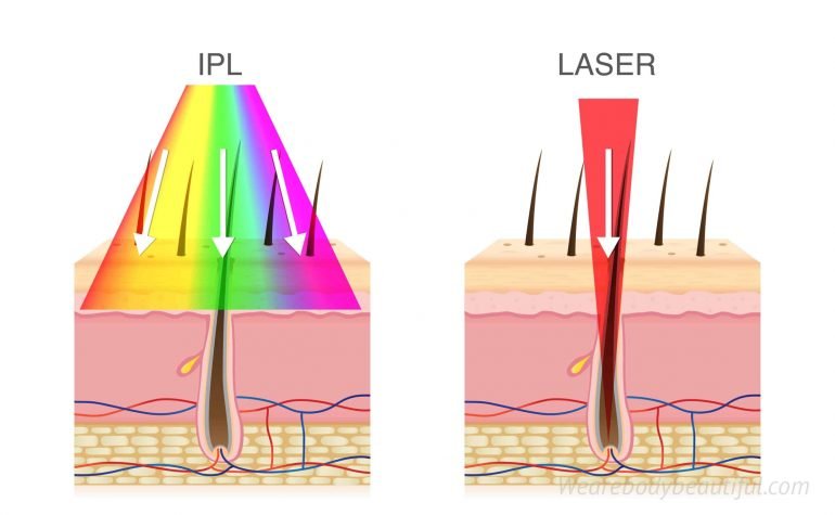 Melanin in our hairs absorbs multi IPL wavelengths and a single monochromatic laser wavelength